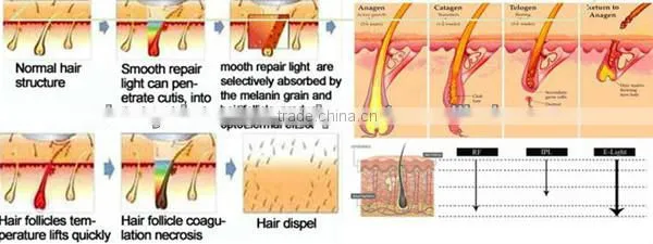 New hottest portable IPL Factory provide hottest selling portable e-light portable ipl portable
