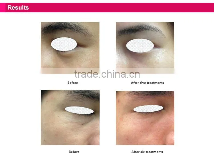 Fashionable appearance Home use face slimming machine/facial beauty equipment