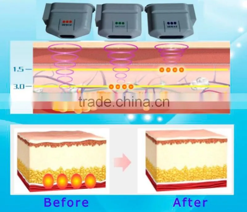 Magnetic resonance guided focused ultrasound effective skin tighten machine HFU10