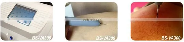 Painless High Frequency Facial Vascular Lesion Removal Beauty Machine