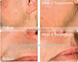 Remove broken veins ipl machine price
