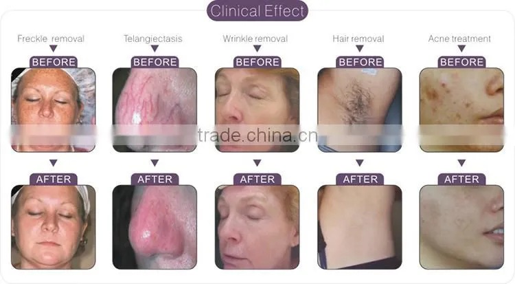 2016 new shape!!! ipl laser permanent facial hair removal for women for beauty salon