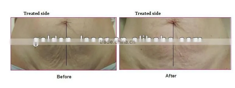 2014 New Style Face and neck tightening and firming Viora Reaction Machine