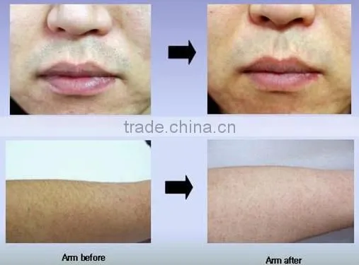 Professional 808NM diode laser 6 types skin hair removal equipment price