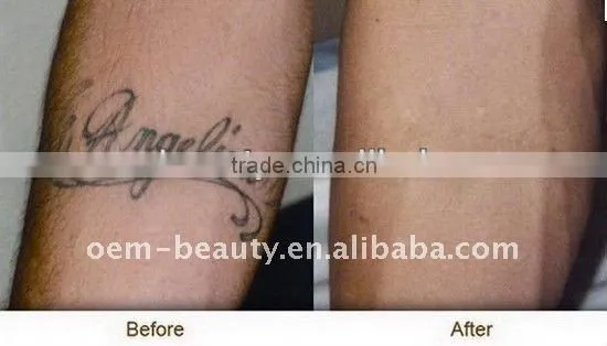 Pro Q Switched nd yag laser tattoo removal machine with 1064nm and 532nm treatment tips