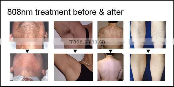 professional 808nm diode laser hair removal machine/ 808nm diode laser for beauty salon/2016 new beauty equipment