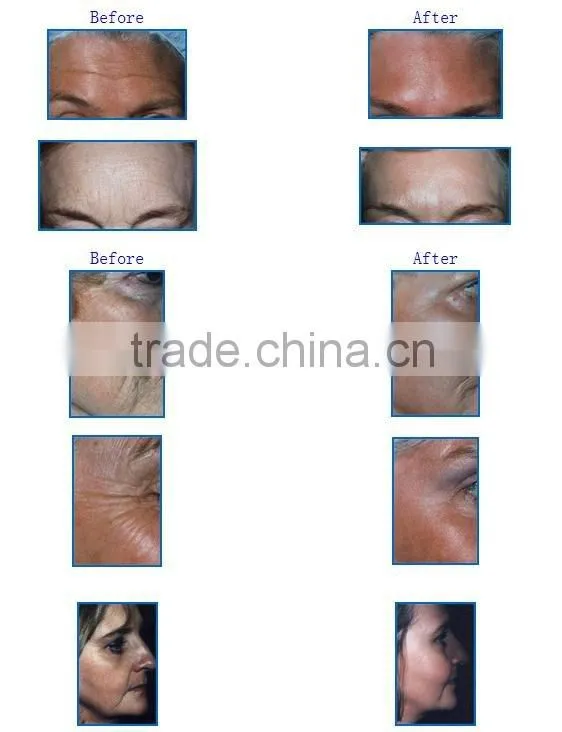 hot sale bi-polar RF beauty equipment