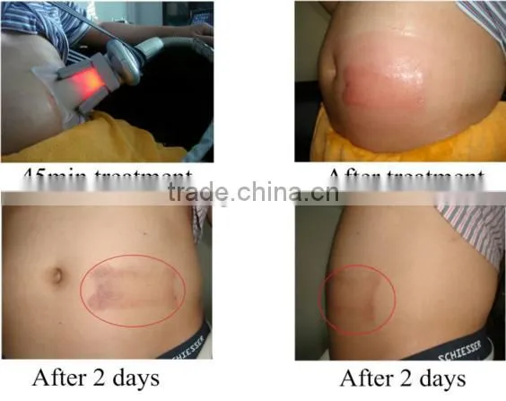 Cavitation multipolar tripolar rf slimming fat reduction machine for beauty