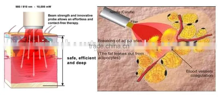 portable Lipolysis Laser Melting fat equipment with 30W 980nm diode laser