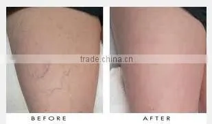 factory price best beauty device / facial veins removal / varicose vein treatment equipment