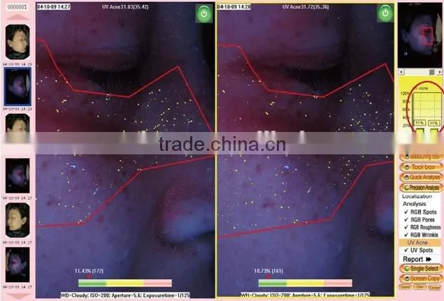 skin analyzer machine 3d skin analyzer facial skin analyzer