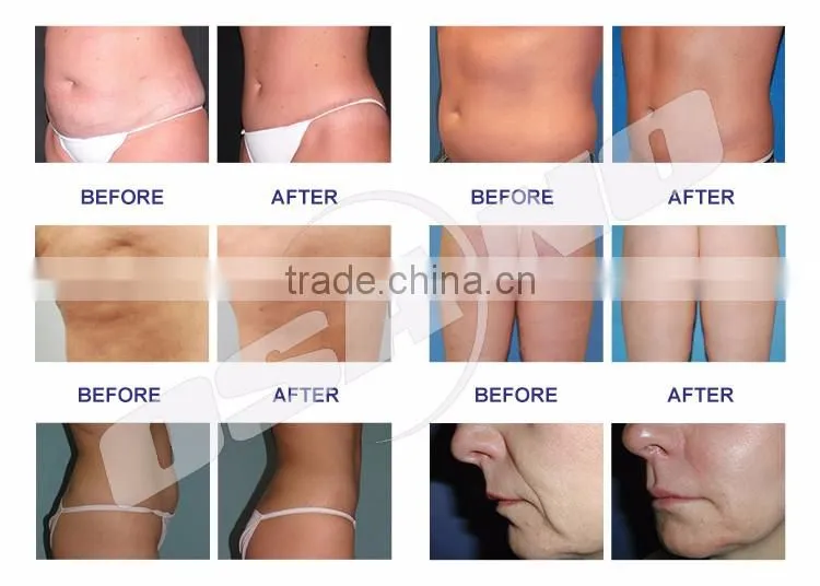 Beauty & Personal Slimming Machine / 40K Ultrasonic Cavitation / Vacuum Radio Frequency