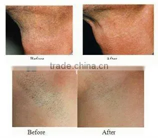 2016 the most advanced professional 808nm diode laser hair removal machine can shot 80000000spots