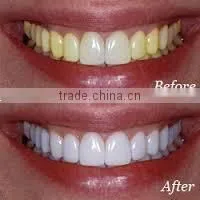 Non Peroxide Teeth Whitening Strips