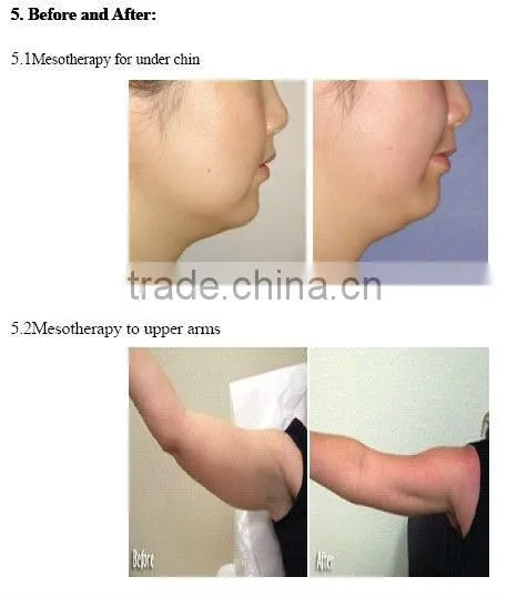 mesotherapy needle medical injection device with CE approval