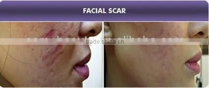 Hot selling auto micro needle system stretch mark removal