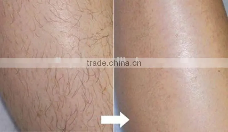 2015 Newest 3 in 1 hair removal handpiece New Hair Removers