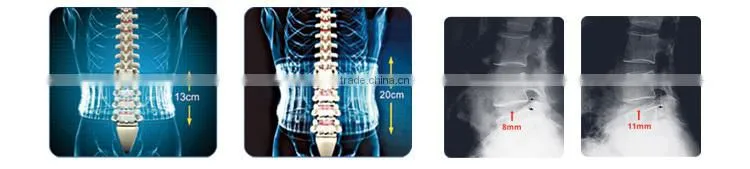 china supplier back pain traction device for muscle strains
