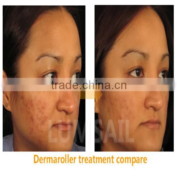 New arrival Derma Roller titanium needle 540 DEEDLE derma roller 0.5 mm derma roler