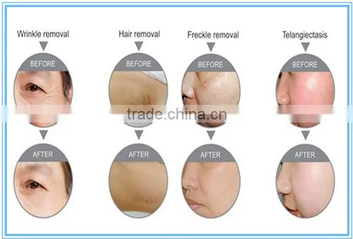 new technology 2 in 1 diode laser hair removal + elight skin rejuvenation