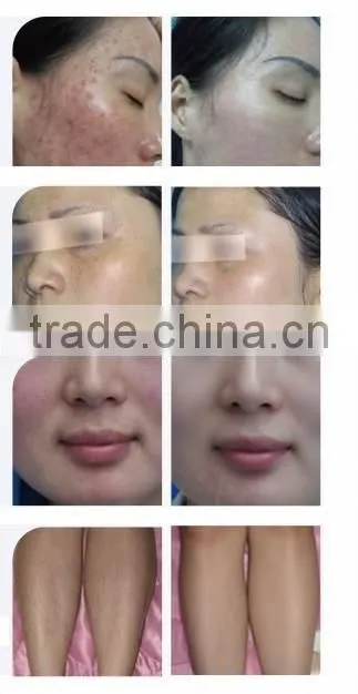 FDA IPL SHR OPT Hair Removal skin rejuvenation beauty salon machine with factory price