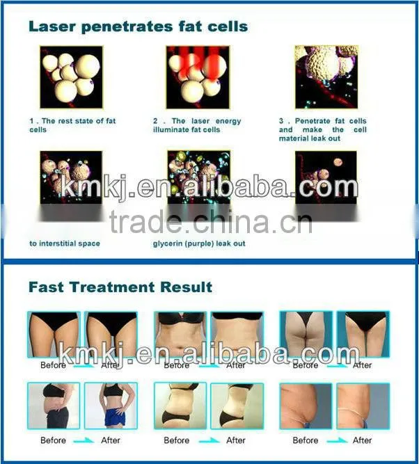 hottest promotion!! professional lipo laser 650nm 940nm with 12 laser pads