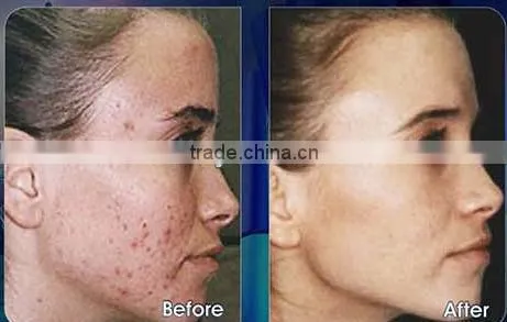 Multi-functional derma roller dermarollerr with beauty package