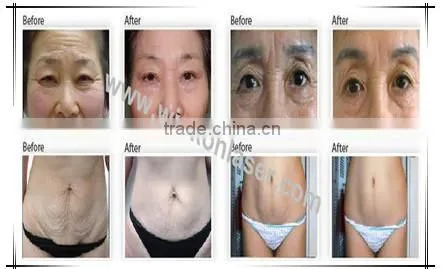 Promotion! fractional rf microneedle skin lifting machine