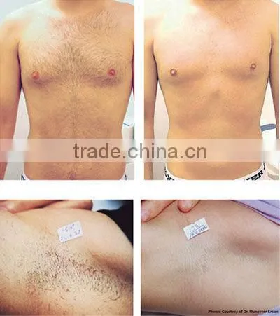 the lasest technology yag laser hair removal machine