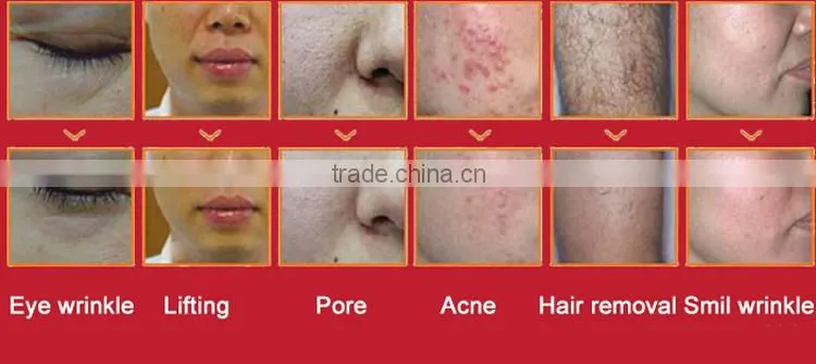 Multifunctional cooling rf face lift 3000w pain free shr epilacia with 3 handle for sale