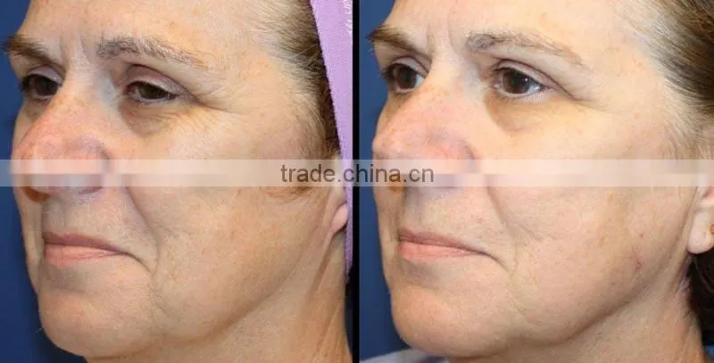 The factory price Rf heating no needle therapy gun no needle mesotherapy machine for salon use