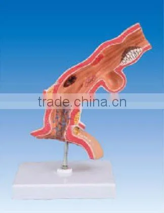 Pathological model of esophagus