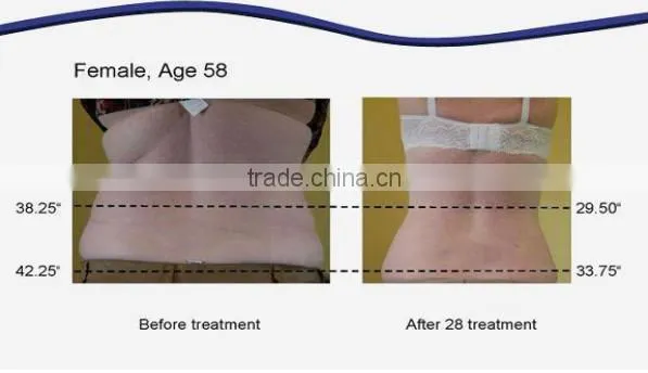 multifunctional lipolaser cavitation rf beauty machine / laser rf skin treatment machine