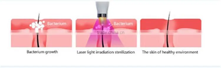 Best effective hot sale soft acne laser removal/acne treatments pen for sale