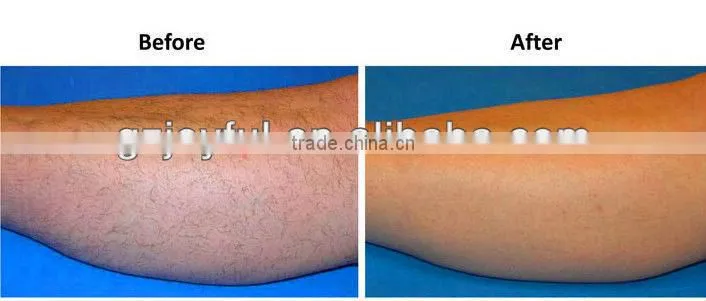 2015 New! Beauty products looking for distributors laser diode 808nm hair removal machine AM-300