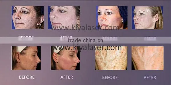 co2 fractional laser for sale