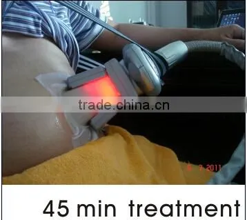 2 cryo handpieces working at the same time to freeze fat off