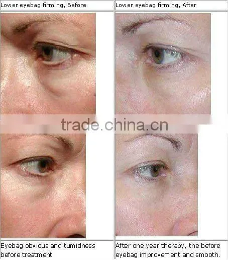 Hottest portable ipl with skin rejuvenation and rf face lifting treatment