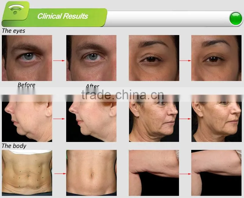Skin tightening machine, 3 different heads,combination of bi-polar RF&vacuum&blue laser technology