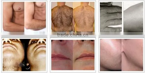 NUBWAY good quality portable multifunctional ipl / hair removal device ipl