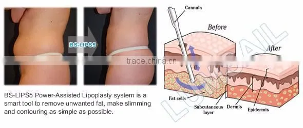 Plastic surgery Power Assisted Surgical liposuction equipment for Plastic surgery