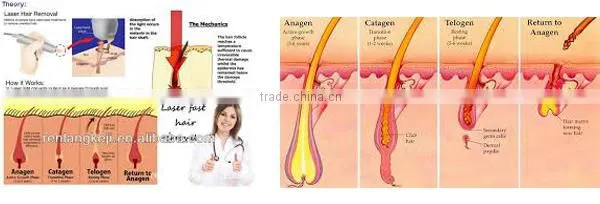 The factory low price promotions! Professional diode laser/808nm diode laser/laser hair removal for permanent hair removal