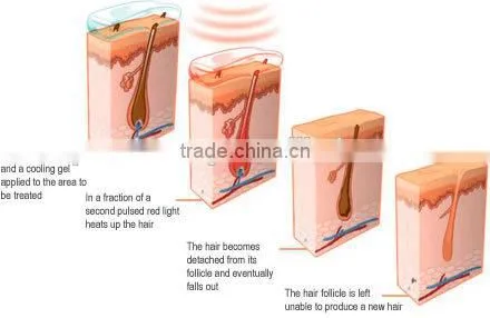 alma laser hair removal machine for sale