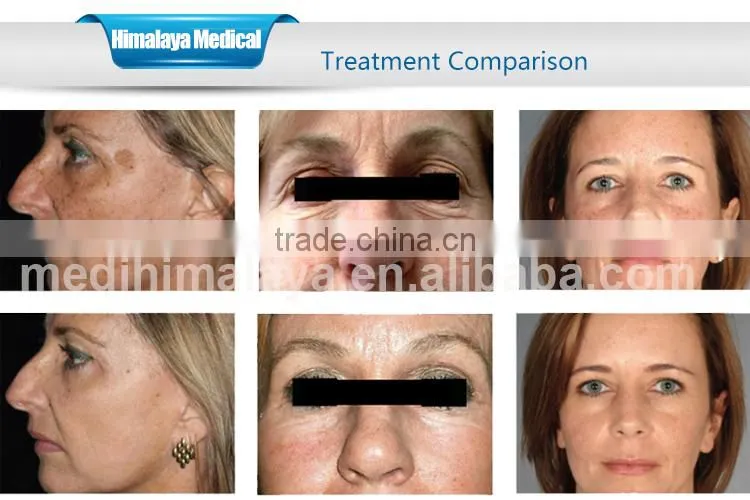 beauty SPA laser newest acne removal laser skin treatment machine