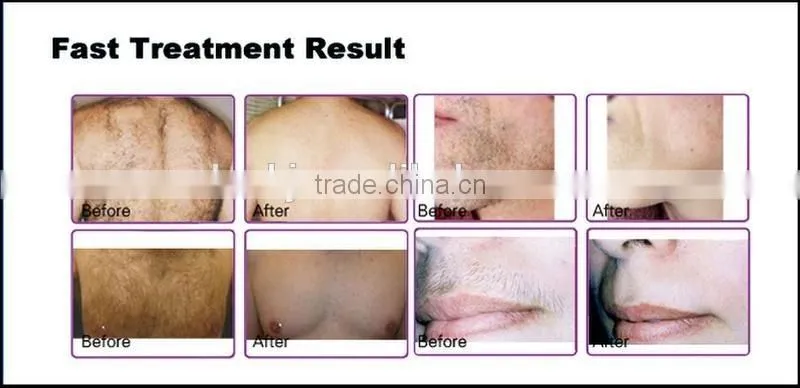 Super cooling! high quality diode 808nm laser hair remover / diode laser