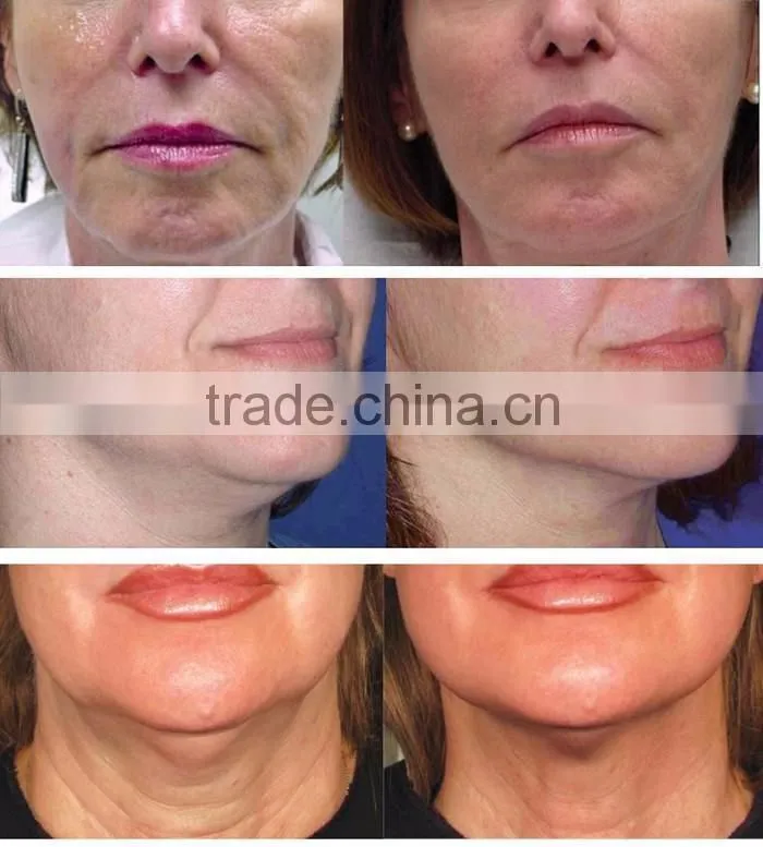 2016 New Products ultrasonic hifu skin care tool home oxygen facial machine factory