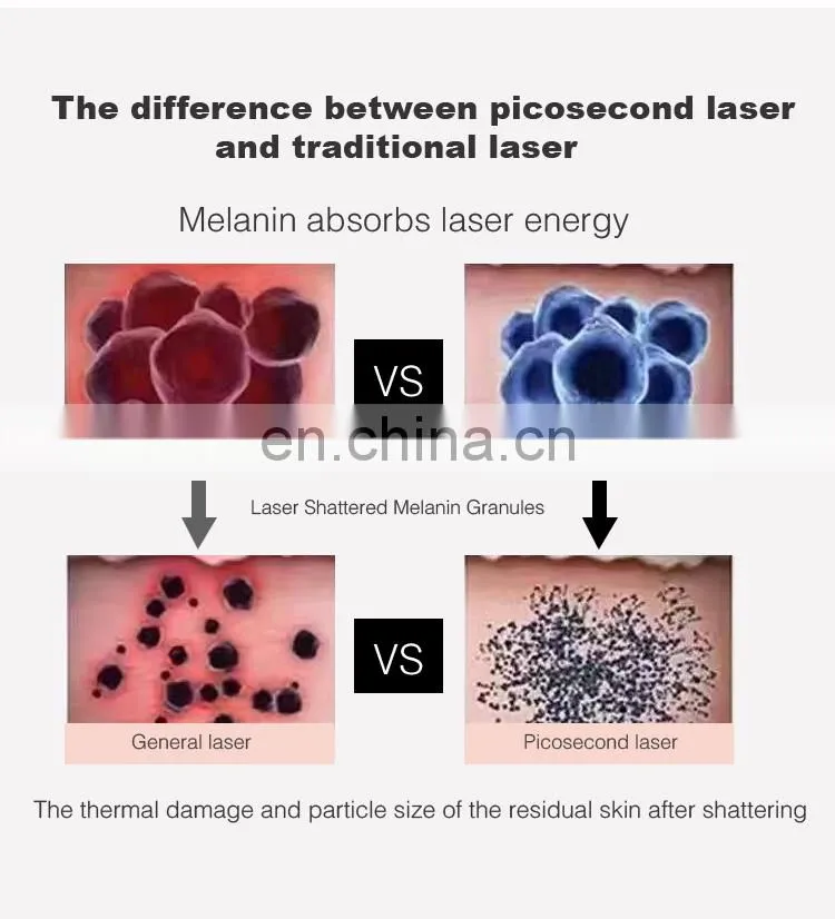 755nm Laser Pico Picosecond Laser Birthmark/ Tattoo Removal Skin Whitening Machine