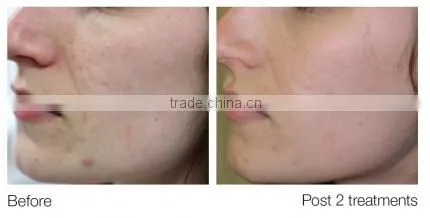 AYJ-X10 radio frequency dermabrasion facial vaccum machine