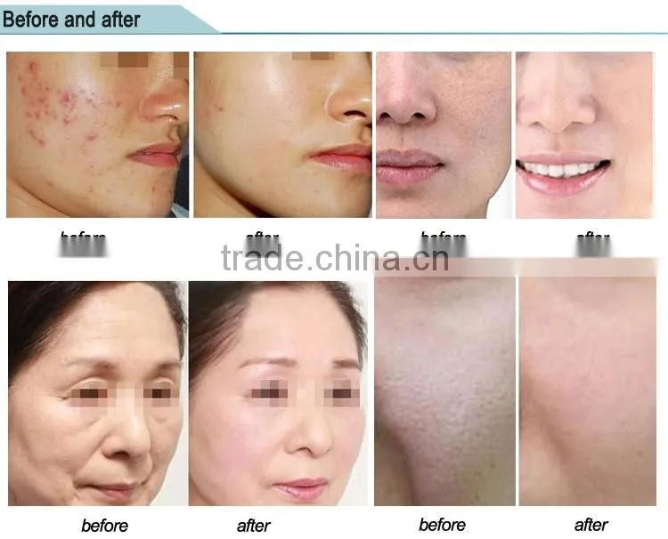 Beauty Spa Equipment Jet Peel Facial Treatment