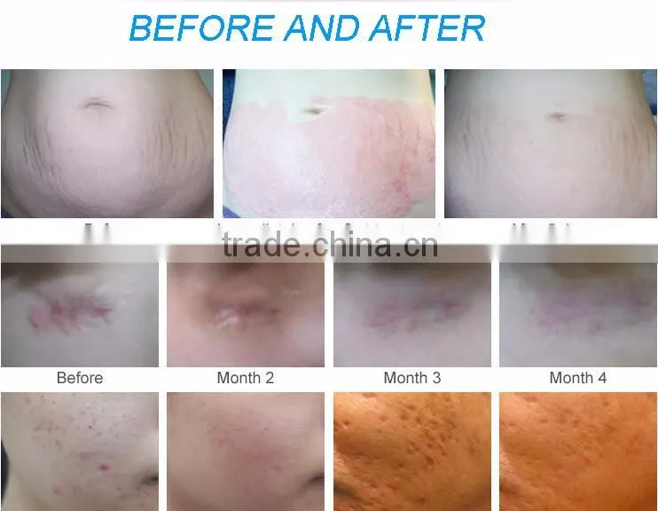 High Quality Distributor Price microneedling maschine/dermapen/derma stamp electric pen